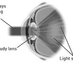 cataract-2