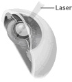 Posterior capsulotomy: a laser is used to make an opening in the cloudy lens capsule.
