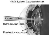 Yag Laser