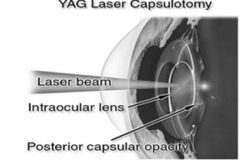 Yag Capsulotomy