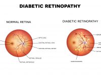 Diabetic Retinopathy Image